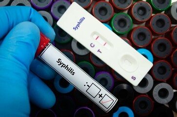 Fototapeta premium Blood sample of patient positive tested for syphilis by rapid diagnostic test.