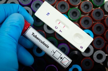 Blood sample of patient positive tested for tuberculosis by rapid diagnostic test. © kitsawet