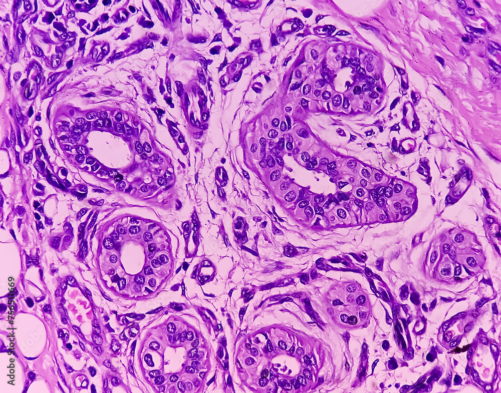 Poster Tissue from axilla (biopsy). Invasive squamous cell carcinoma. Smear show skin, invasive squamous cell carcinoma. Skin cancer.