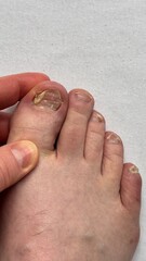 Toenail fungus of unhealthy person. Nails affected by a fungal infection. Onycholysis of nails....
