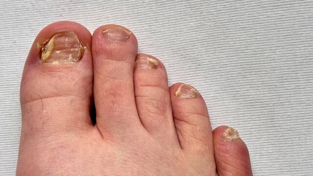 Toenail fungus of unhealthy person. Nails affected by a fungal infection. Onycholysis of nails. Close-up.