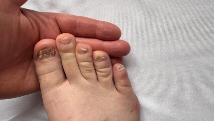 Toenail fungus of unhealthy person. Nails affected by a fungal infection. Onycholysis of nails....