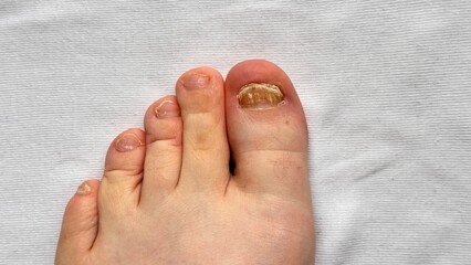 Fungus Onycholysis infection of on nails of man's toenail fungus. Close-up.