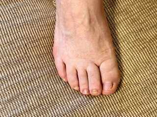 Fungus Onycholysis infection of on nails of woman's toenail fungus. Close-up.