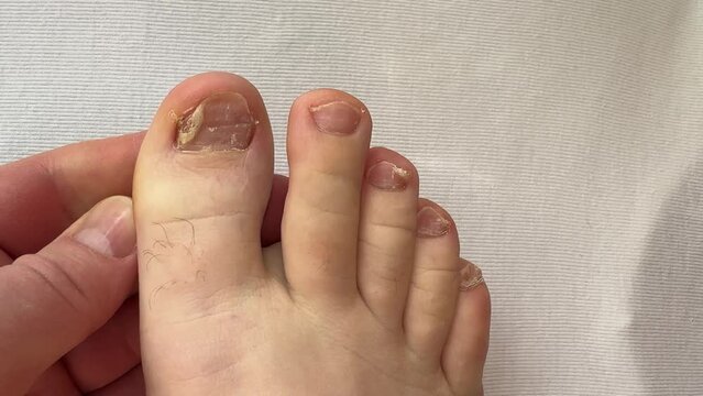 Close-up of the person nails affected by nail plate fungus. Ugly toes. Onycholysis of nails. Close-up.
