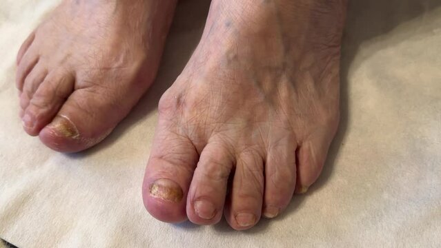 Fungus Onycholysis infection of on nails of woman's toenail fungus. Close-up.