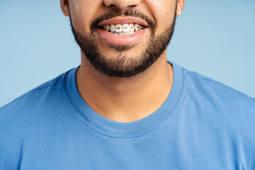 Closeup view of smiling man with dental braces posing isolated