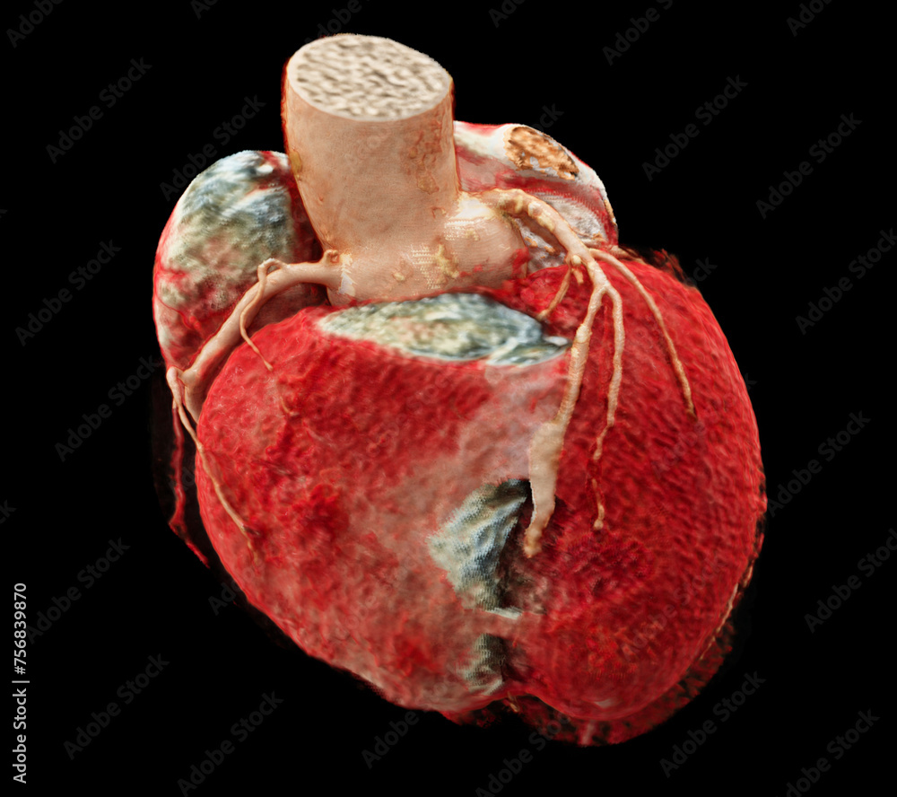 Poster cta coronary artery 3d rendering image showing coronary tree and heart 3d.