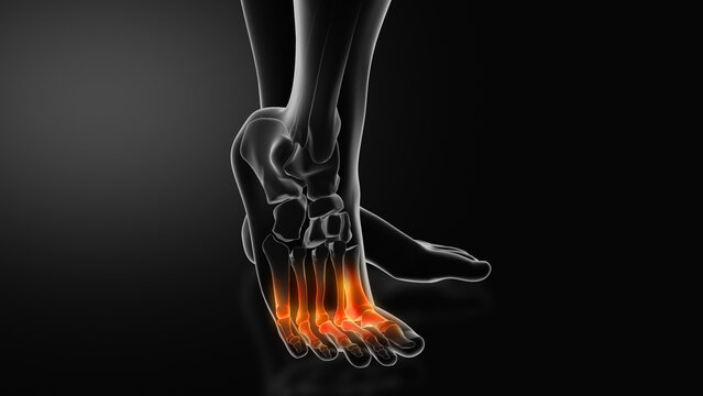 Metatarsalgia or Ball of Foot Pain