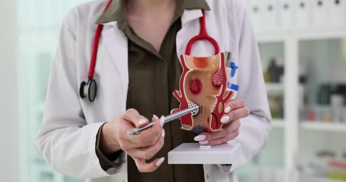Proctologist shows rectum with hemorrhoids realistic model