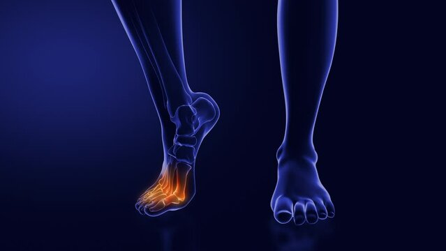 Ball of foot pain or Metatarsalgia