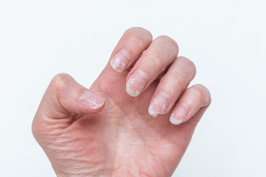Bitten and broken nails without manicure with an overgrown cuticle of the nail and a damaged nail plate after applying gel polish. A woman's palm. Cosmetic procedures. Nail and hand care.