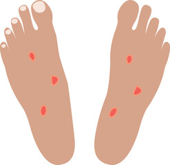 Diabetic foot, ulcer and disease, diabetic foot vector icon, vector graphics