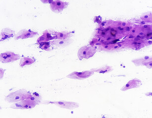 Light micrograph of Paps smear: Inflammatory smear with HPV related changes. Cervical cancer. SCC...