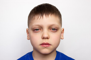 Close-up portrait of a child with red puffy eyes, isolated on a white background. Unhealthy...