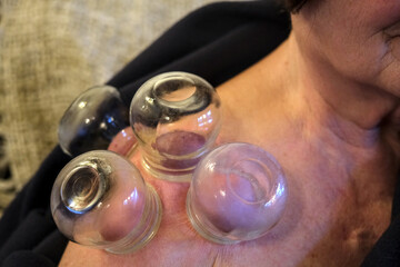 Cupping therapy on a shoulder of a 70 years old woman.
