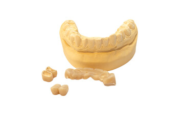 Dental prosthesis and teeth molds on white background