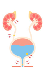 尿路結石の医療イラスト、腎結石・尿管結石・膀胱結石・尿道結石