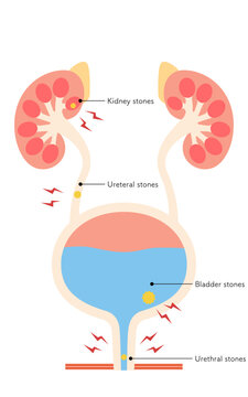 Medical illustration of urinary tract stones, kidney stones, ureteral stones, bladder stones, urethral stones