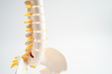 Lumbar spine displaced herniated disc fragment, spinal nerve and bone. Model with copy space for...