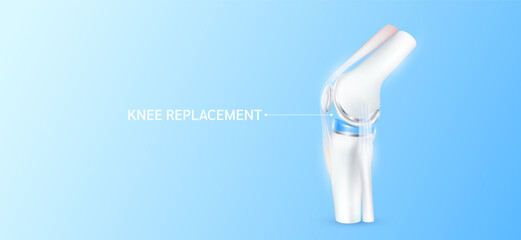 Total knee replacement or implant for treatment relieve arthritis, after joint damaged. Leg bone and cartilage ligaments side. Medical health care science technology concept. 3D vector. - obrazy, fototapety, plakaty