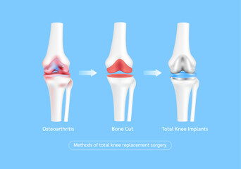 Methods of total knee replacement surgery or implant. Osteoporosis or severe arthritis joint. Leg bone cartilage. Innovation medical technology treatment. Vector.