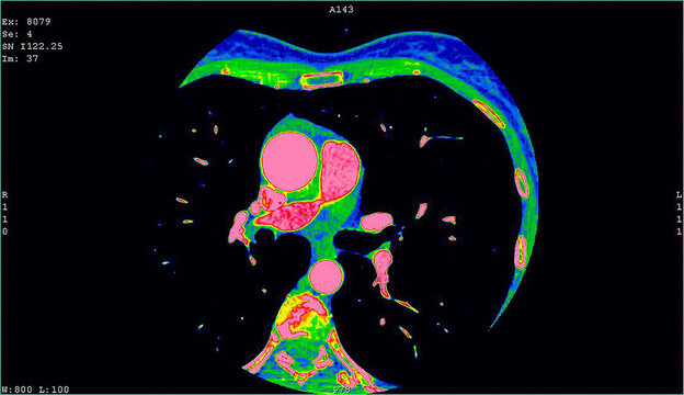 A computerized tomography CT coronary angiogram. Axial contrast of the cardio system (heart) with radiology