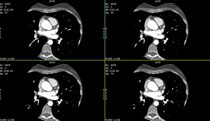 A computerized tomography CT coronary angiogram. Axial contrast of the cardio system (heart) with...