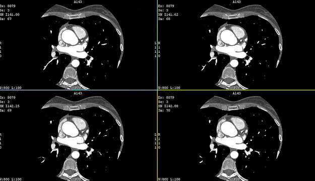 A computerized tomography CT coronary angiogram. Axial contrast of the cardio system (heart) with radiology