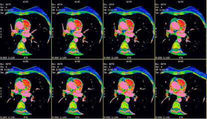 Contrast CT scan of the heart (Cardiac CT angio)