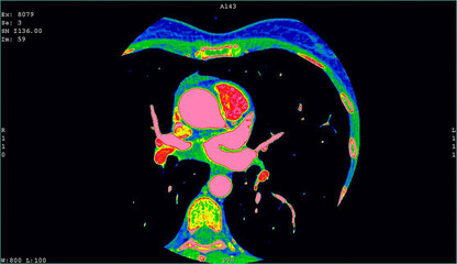 Axial images showing a thymic carcinoma CT cardiac scan. Computer tomography image of the heart