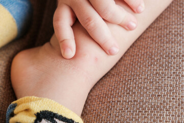 Mosquito bites sore on toddlers legs, many wounds and scars on legs of little boy sitting on bed