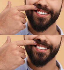 Man showing gum before and after treatment on beige background, collage of photos