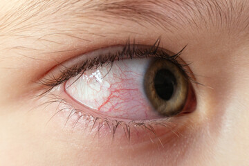 Closeup irritated infected red bloodshot eyes, conjunctivitis