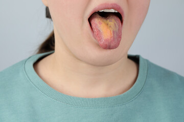 Gastrointestinal diseases. Woman showing her yellow tongue on light grey background, closeup