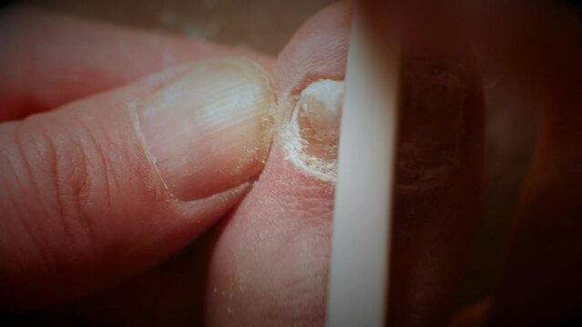 Well-lit macro shot enthusiastically filing down big toe nail with fungal infection, revealing detail.