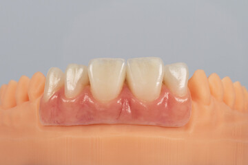 Dental model of teeth front view. Artificial ceramic crowns and silicone gums.