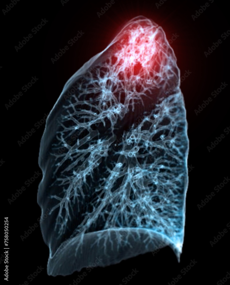 Aufkleber a ct chest 3d scan displaying a lesion at the right upper lobe offers a detailed visualization, aidi