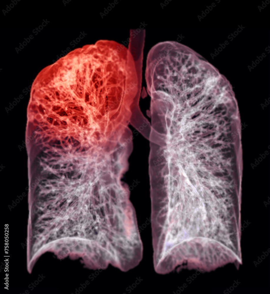Poster a ct chest 3d scan displaying a lesion at the right upper lobe offers a detailed visualization, aidi