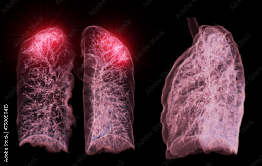 Poster a ct chest 3d scan displaying a lesion at the right upper lobe offers a detailed visualization, aidi