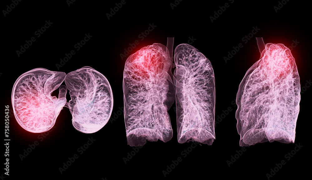Aufkleber a ct chest 3d scan displaying a lesion at the right upper lobe offers a detailed visualization, aidi