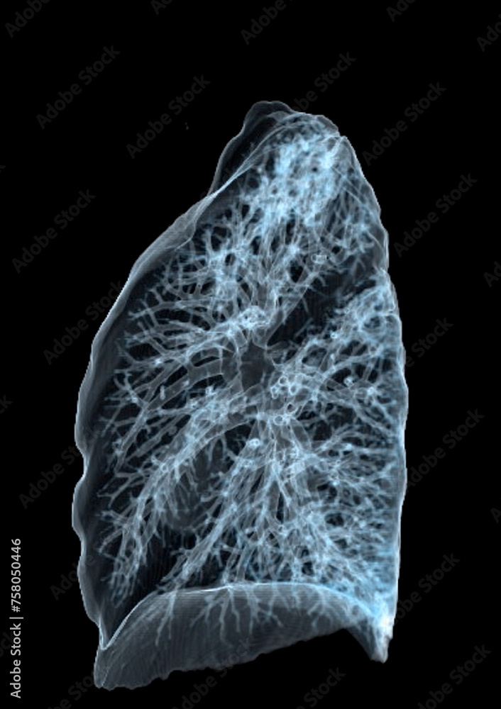 Poster a ct chest 3d scan displaying a lesion at the right upper lobe offers a detailed visualization, aidi