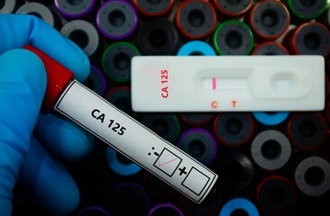 Obraz premium Blood sample of patient negative tested for CA-125 by rapid diagnostic test.