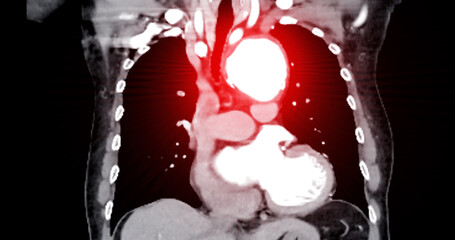 CTA whole aorta imaging displaying an aortic aneurysm provides a comprehensive evaluation.