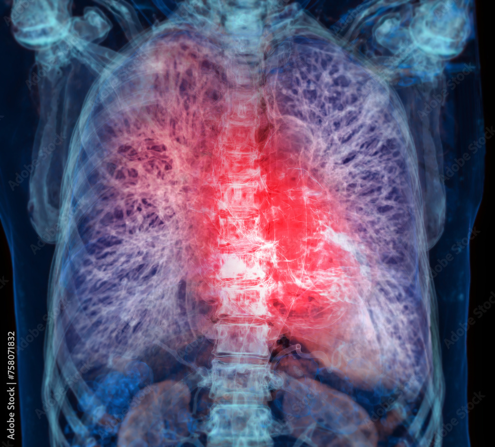 Poster ct chest or lung 3d rendering image showing trachea and lung in respiratory system..