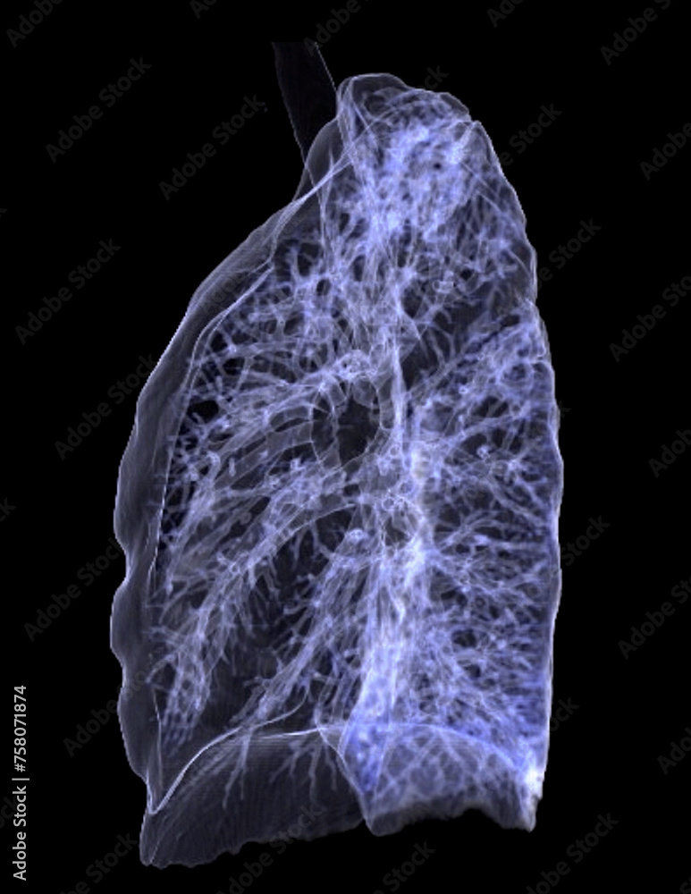 Poster ct chest or lung 3d rendering image showing trachea and lung in respiratory system..