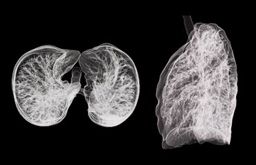 A CT chest 3D scan displaying a lesion at the right upper lobe offers a detailed visualization,...