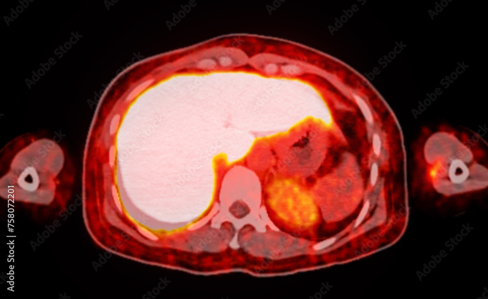 Poster a pet-ct scan image is a diagnostic visualization combining positron emission tomography (pet) and c