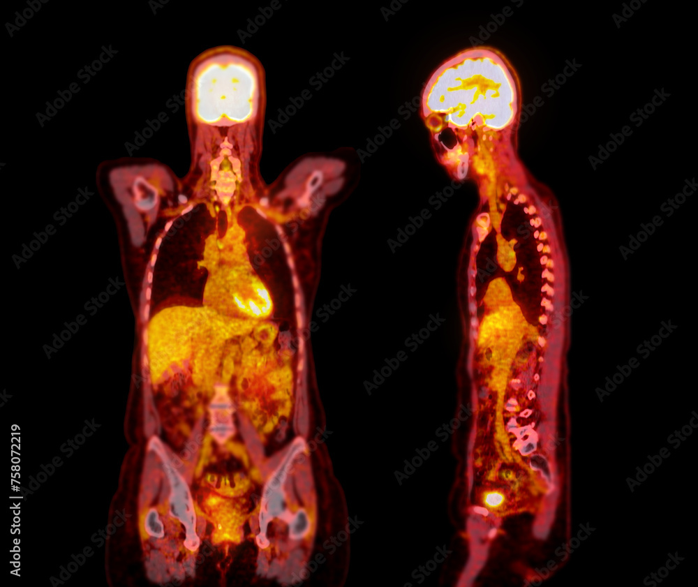Poster a pet-ct scan image is a diagnostic visualization combining positron emission tomography (pet) and c