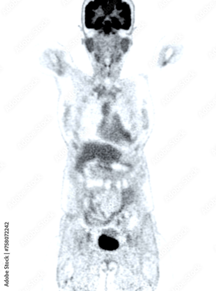Poster a pet-ct scan image is a diagnostic visualization combining positron emission tomography (pet) and c